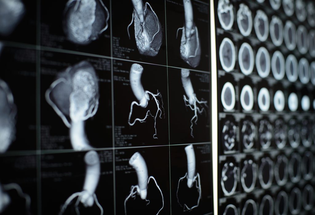 Coronary heart scan 