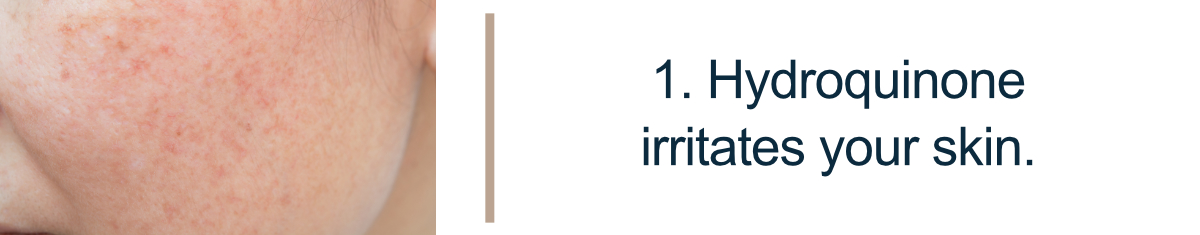 1. Hydroquinone irritates your skin.