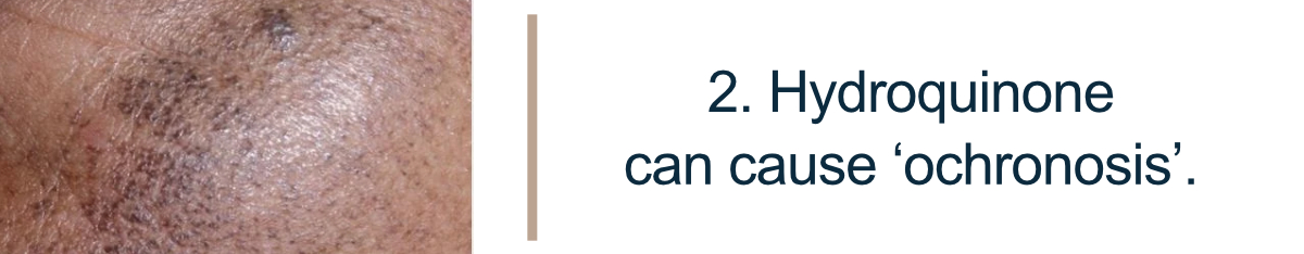 2. Hydroquinone can cause ‘ochronosis’.