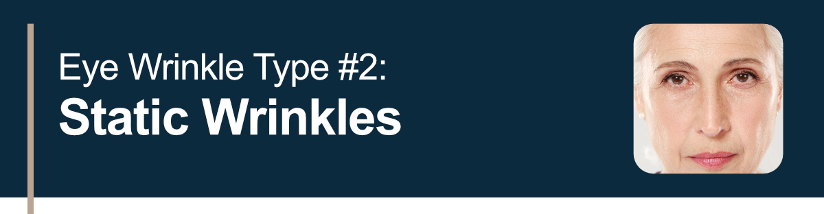 Eye Wrinkle Type #2: Static Wrinkles